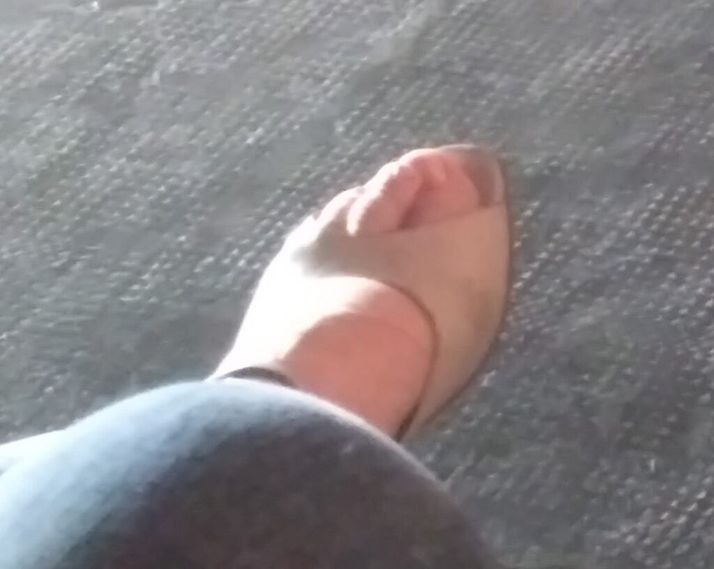 deformed feet dancer 1